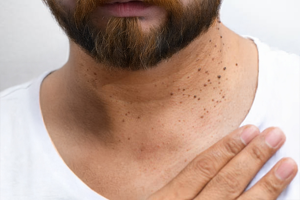 "Macro-photographie d’acrochordons (skin tags) localisés sur le cou d’un homme, montrant des excroissances cutanées bénignes sur fond blanc, utilisée pour illustrer le diagnostic dermatologique et les traitements esthétiques des acrochordons.