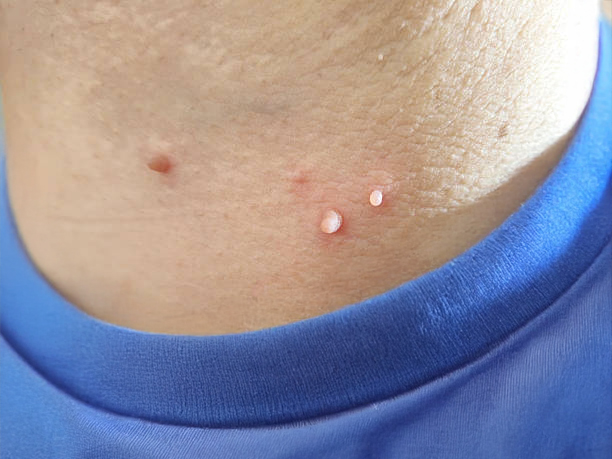 Peau humaine présentant plusieurs acrochordons, montrant des excroissances cutanées bénignes typiques des skin tags, utilisées pour illustrer le diagnostic dermatologique et les traitements esthétiques des acrochordons.