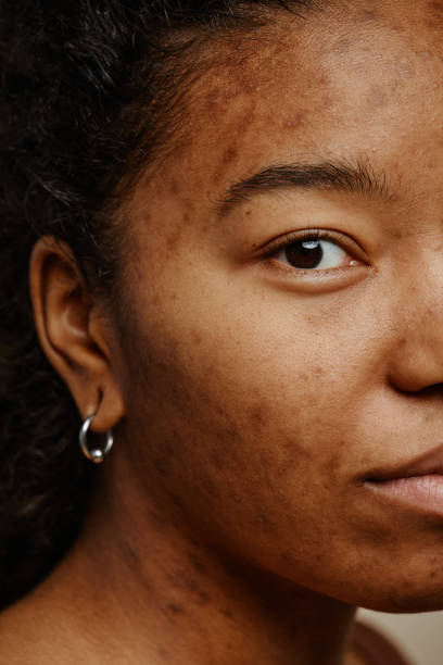 "Macro vertical du visage d’une jeune femme noire présentant des cicatrices d’acné, mettant en évidence les irrégularités cutanées et l’hyperpigmentation post‑inflammatoire, utilisée pour illustrer le diagnostic dermatologique et les traitements esthétiques des peaux noires et métissées.