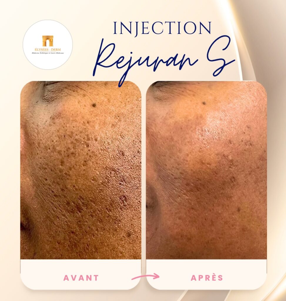Photo avant après homme après une Injection Rejuran S clinique médecine esthétique paris 8 Elysées Derm